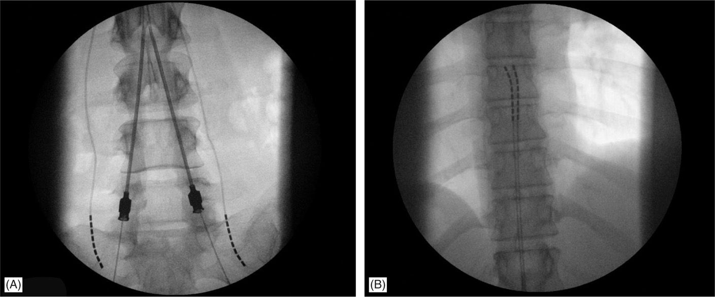 Spinal Cord Stimulation Implantation Techniques Anesthesia Key