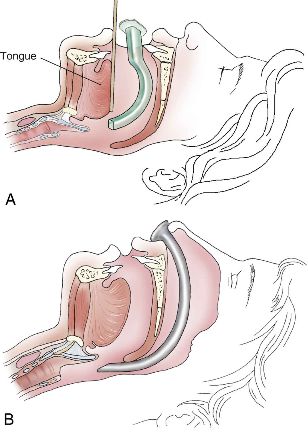 Assessment and Management of the Airway Anesthesia Key