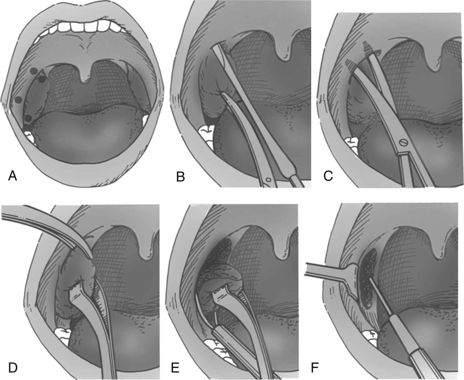 Care of the Ear, Nose, Throat, Neck, and Maxillofacial Surgical Patient