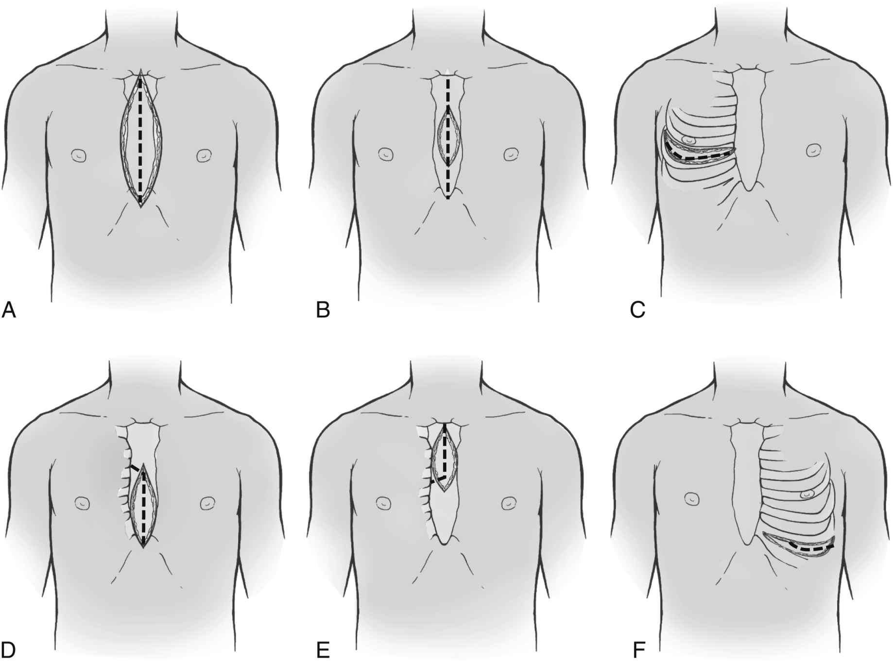 Care of the Cardiac Surgical Patient Anesthesia Key