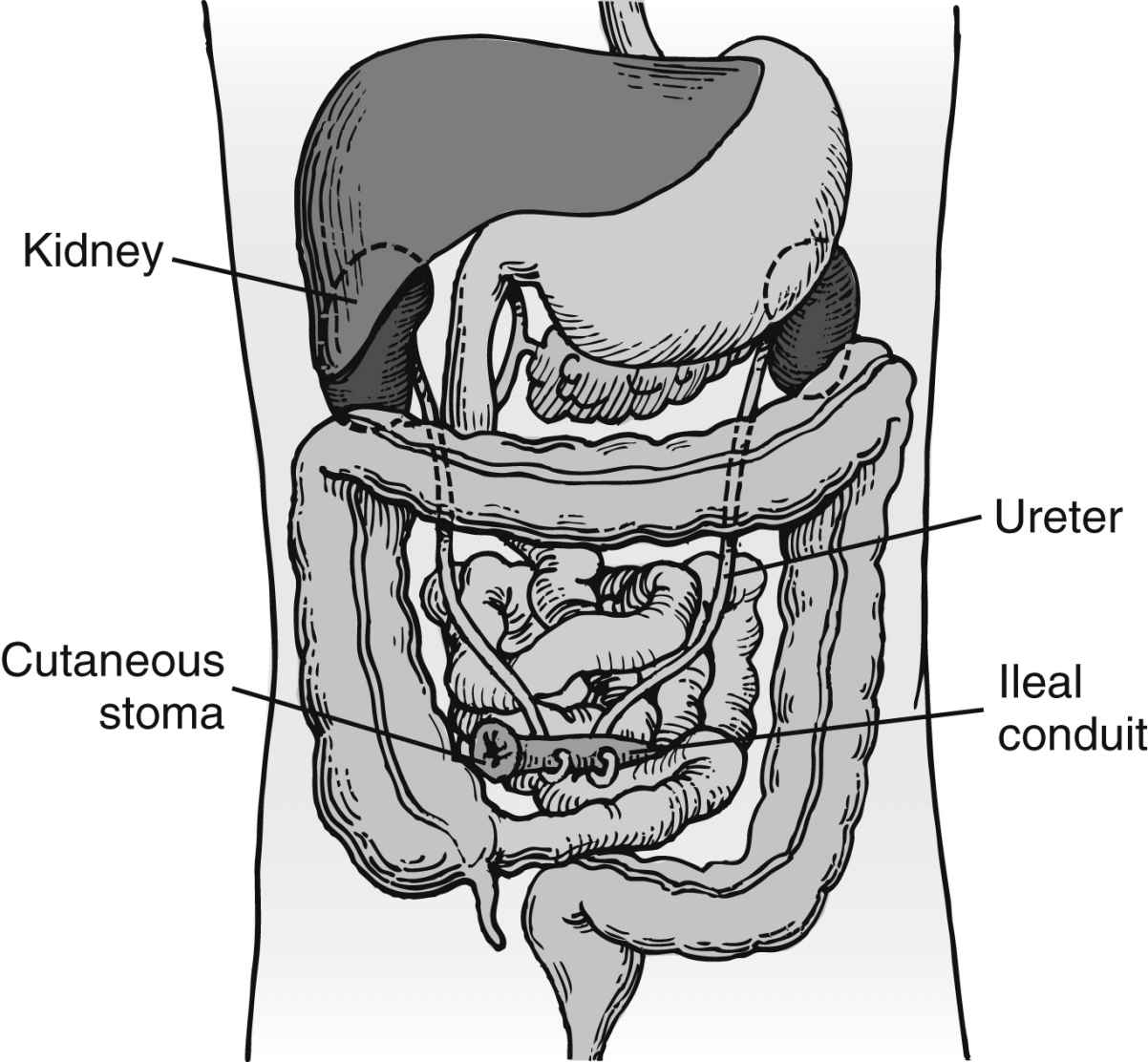 Care of the Genitourinary Surgical Patient Anesthesia Key