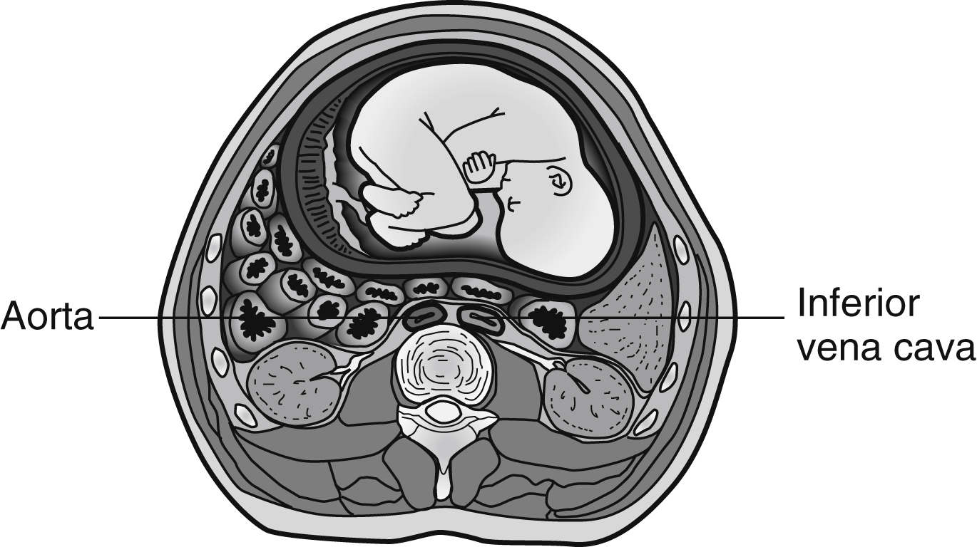 Care of the Pregnant Patient Anesthesia Key