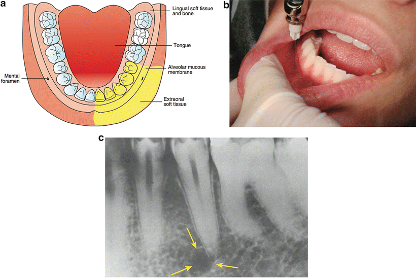 Local and Regional Anesthesia in Dental and Oral Surgery Anesthesia Key