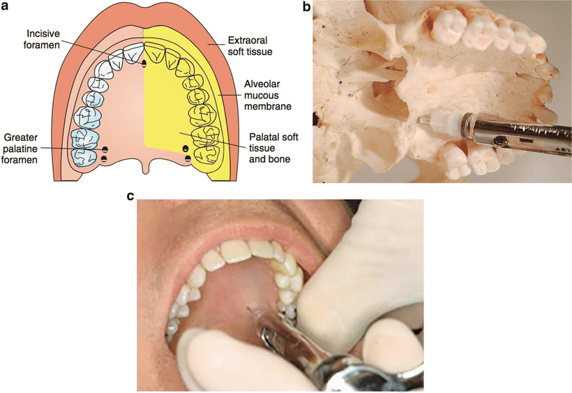 Local and Regional Anesthesia in Dental and Oral Surgery Anesthesia Key