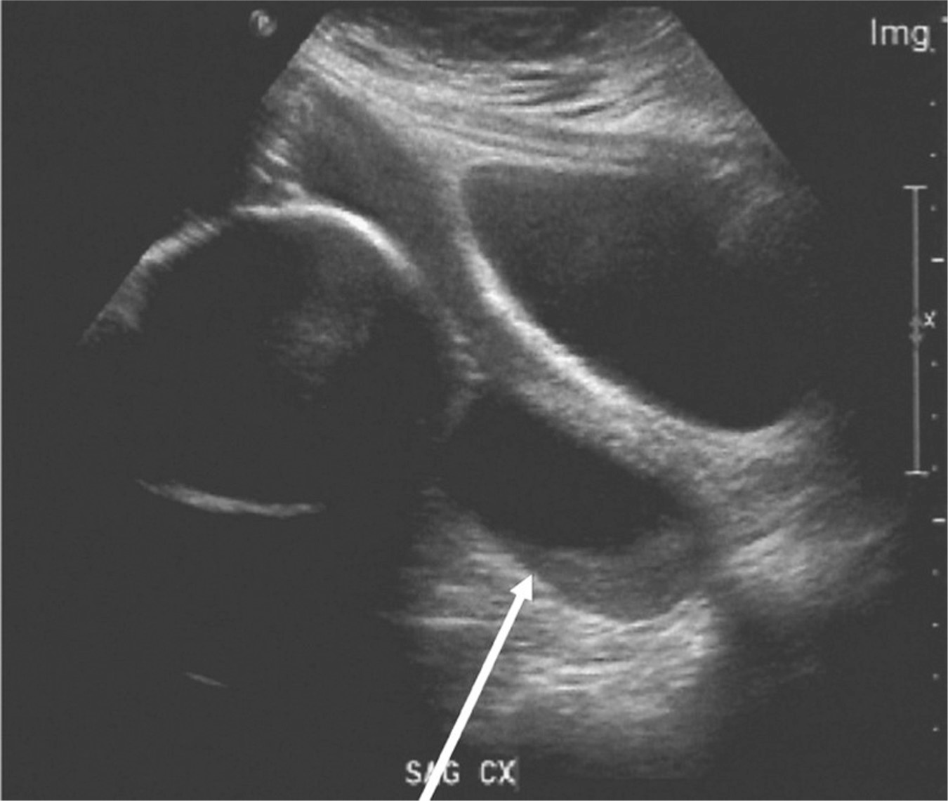 Periviable Obstetric Management Anesthesia Key