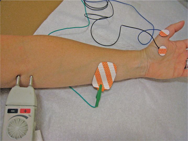 EMG and Nerve Conduction Studies Anesthesia Key