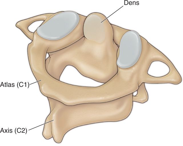 AtlantoAxial Joint Injections Anesthesia Key