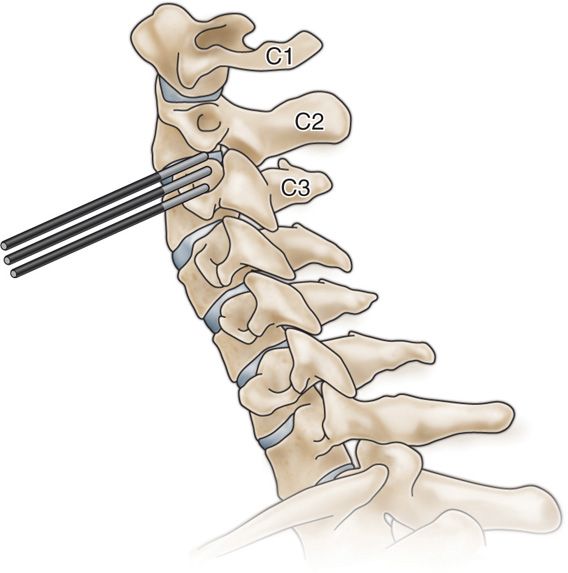 Occipital Nerve Blocks Anesthesia Key