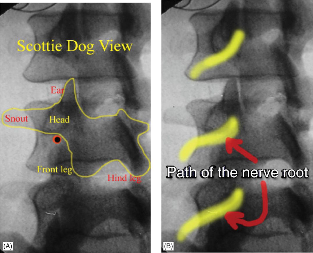 Transforaminal Epidural Steroid Injection Anesthesia Key