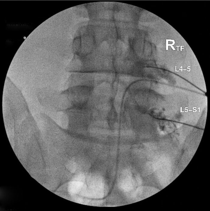 Dorsal Root Ganglion Blocks and Radiofrequency Procedures Anesthesia Key
