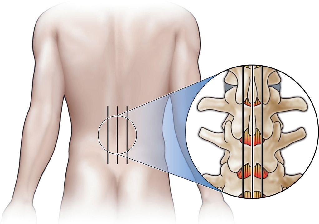 Minimally Invasive Lumbar (MILD procedure) Anesthesia Key