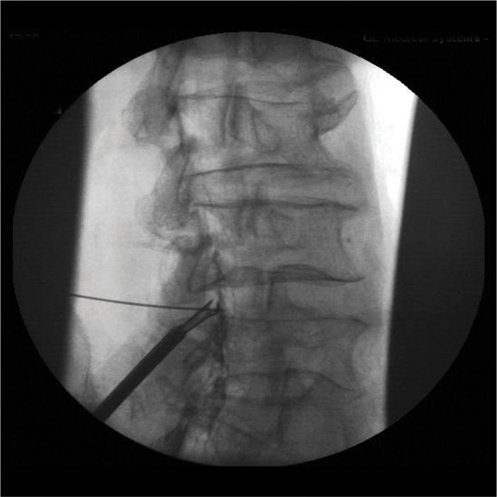 Minimally Invasive Lumbar (MILD procedure) Anesthesia Key