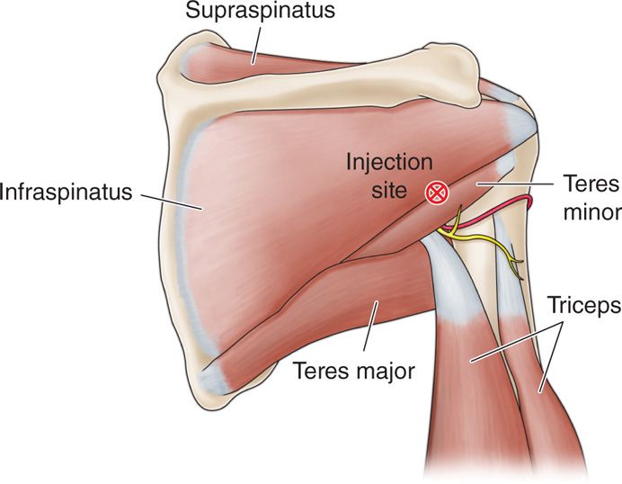 IntraArticular Joint Injections Anesthesia Key