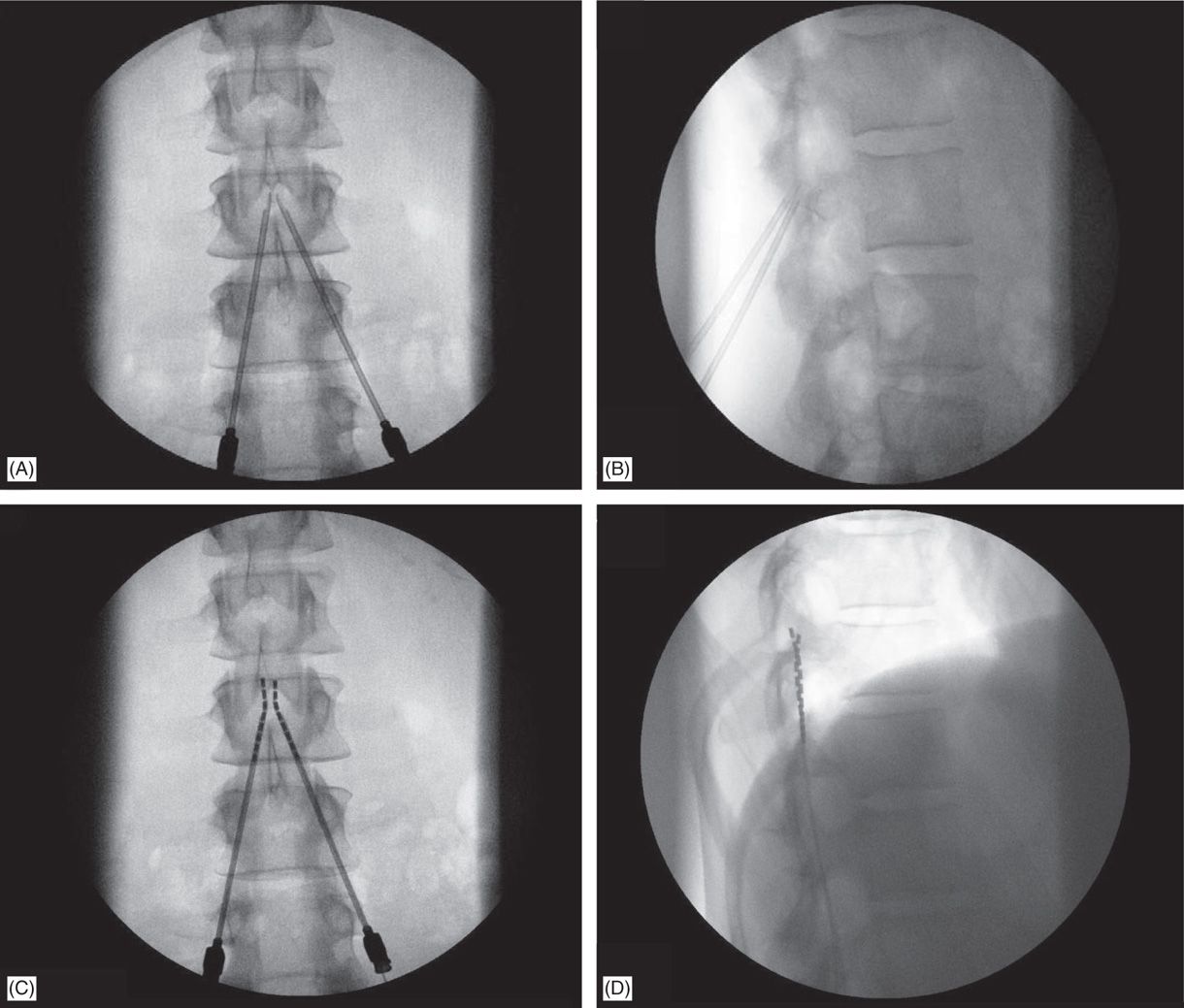 Spinal Cord Stimulation Implantation Techniques Anesthesia Key