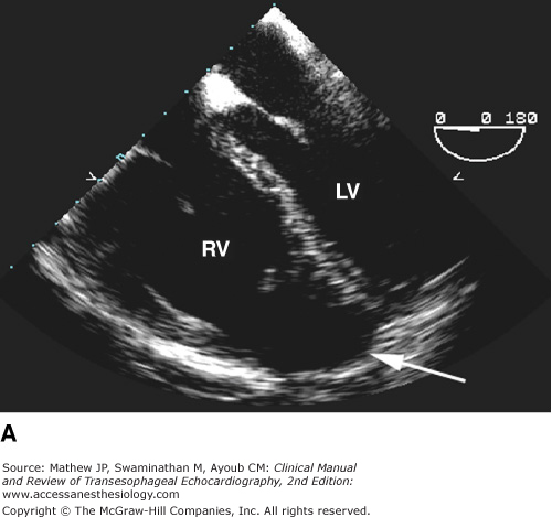 TEE for Noncardiac Surgery | Anesthesia Key