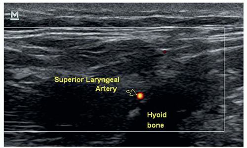 Ultrasound-Guided Superior Laryngeal Nerve Block | Anesthesia Key