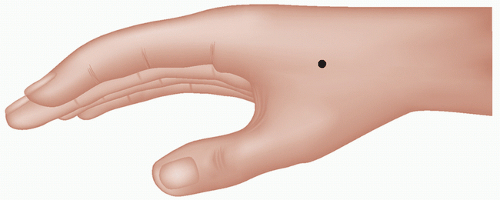 Acupuncture | Anesthesia Key