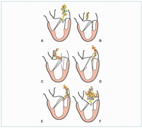 Mitral Regurgitation | Anesthesia Key