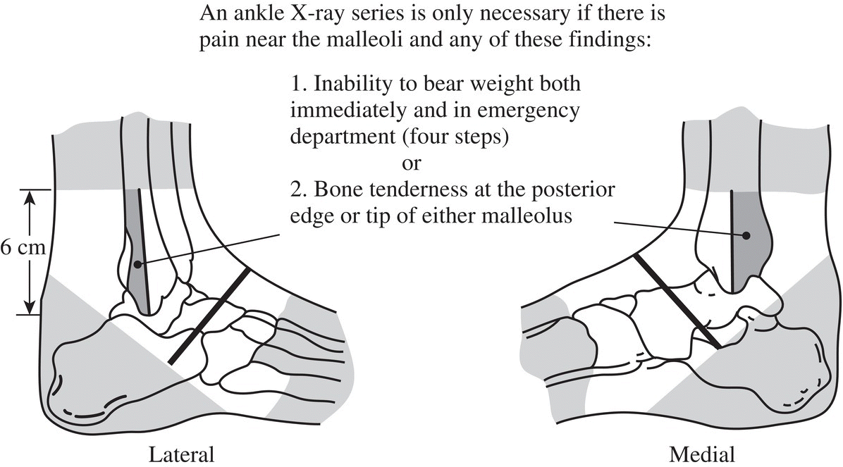 Acute Ankle and Foot Injuries Anesthesia Key