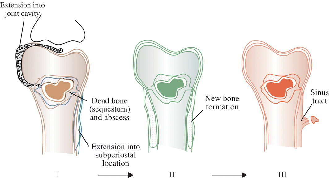 Osteomyelitis Anesthesia Key