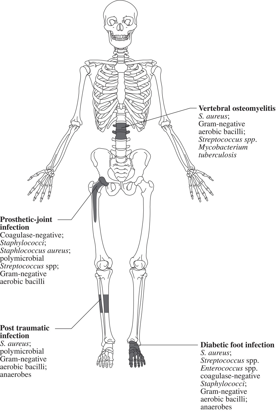 Osteomyelitis Anesthesia Key