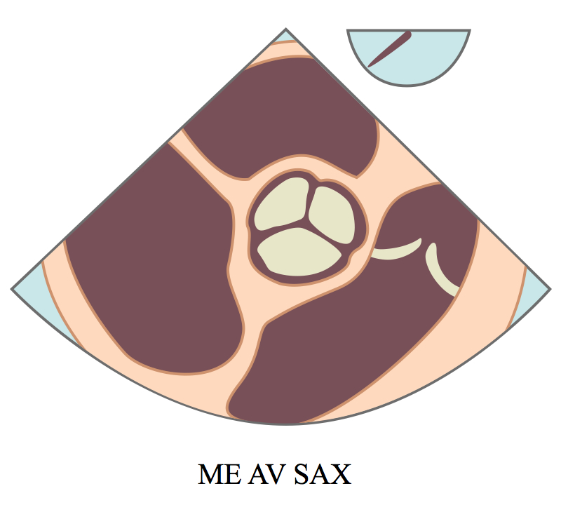 MidEsophageal Aortic Valve Short Axis View