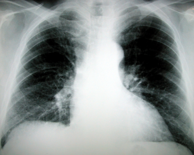 Lung Cancer Screenings Beneficial to Many