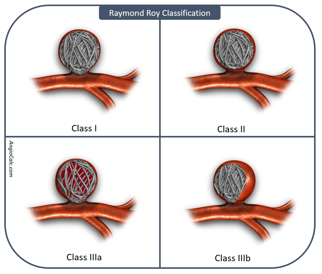AngioCalc Cerebral and Peripheral Aneurysm Calculator