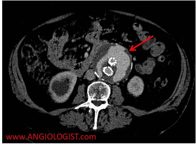 Endoleak: Diagnosis, Types and Treatment Options
