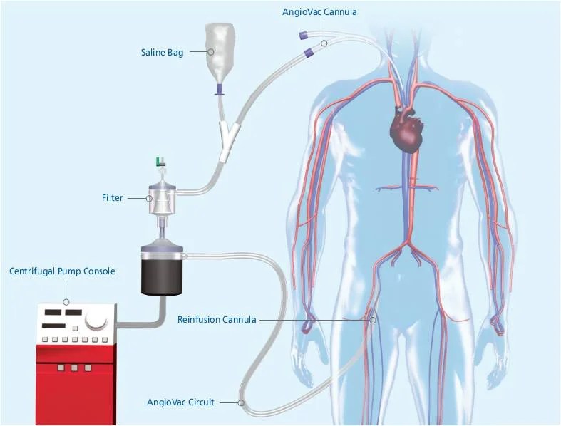Vortex® for Pulmonary Embolism Angiologist
