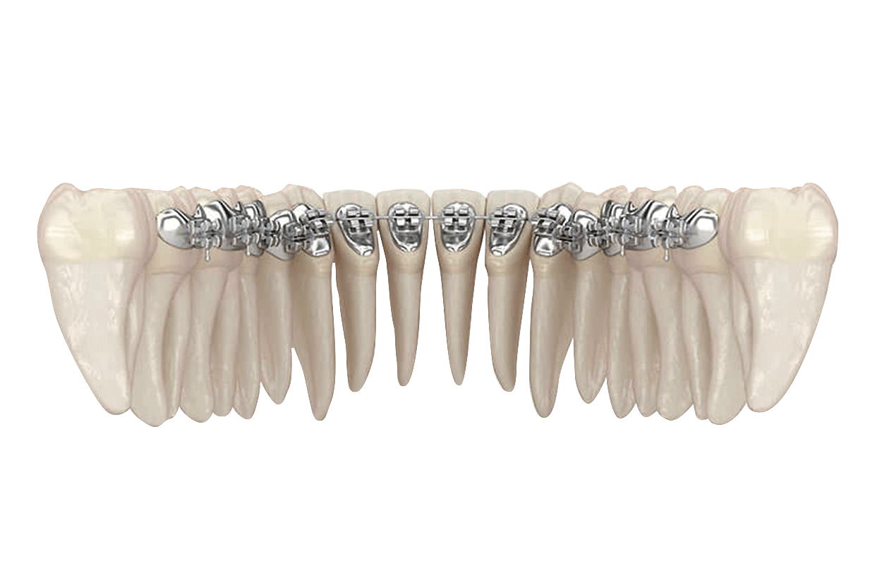 Lingual Braces Angle House