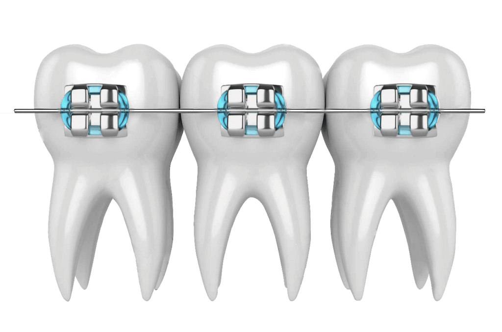Metal Braces Orthodontics Treatment, London Angle House