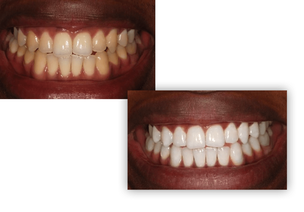 Teeth Whitening Angle House
