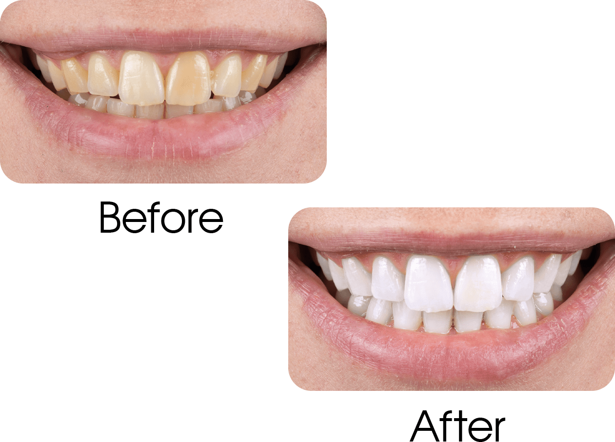 Teeth Whitening Angle House