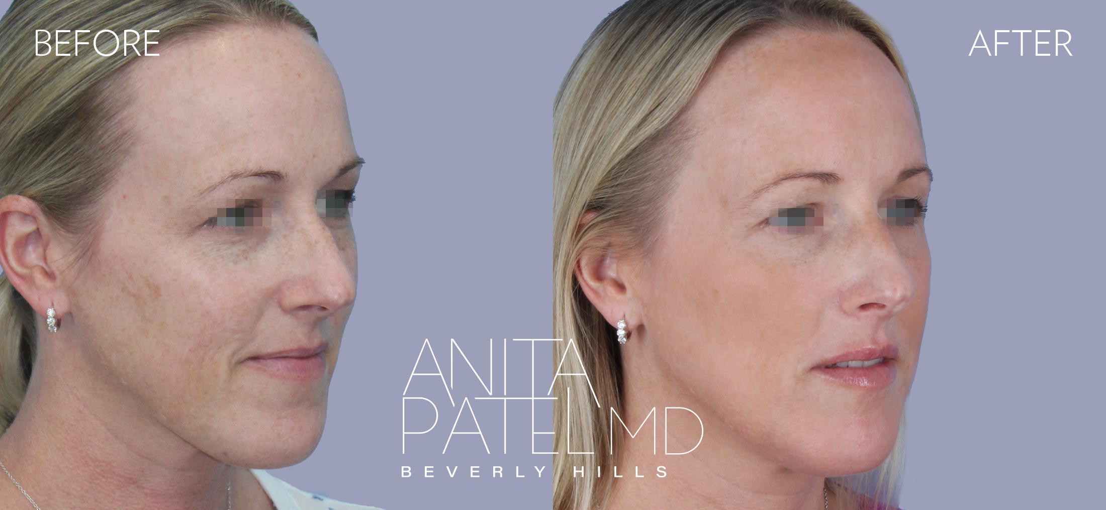 Cynosure® Palomar Icon™ 1540 Fractional Laser Aesthetic Treatment in