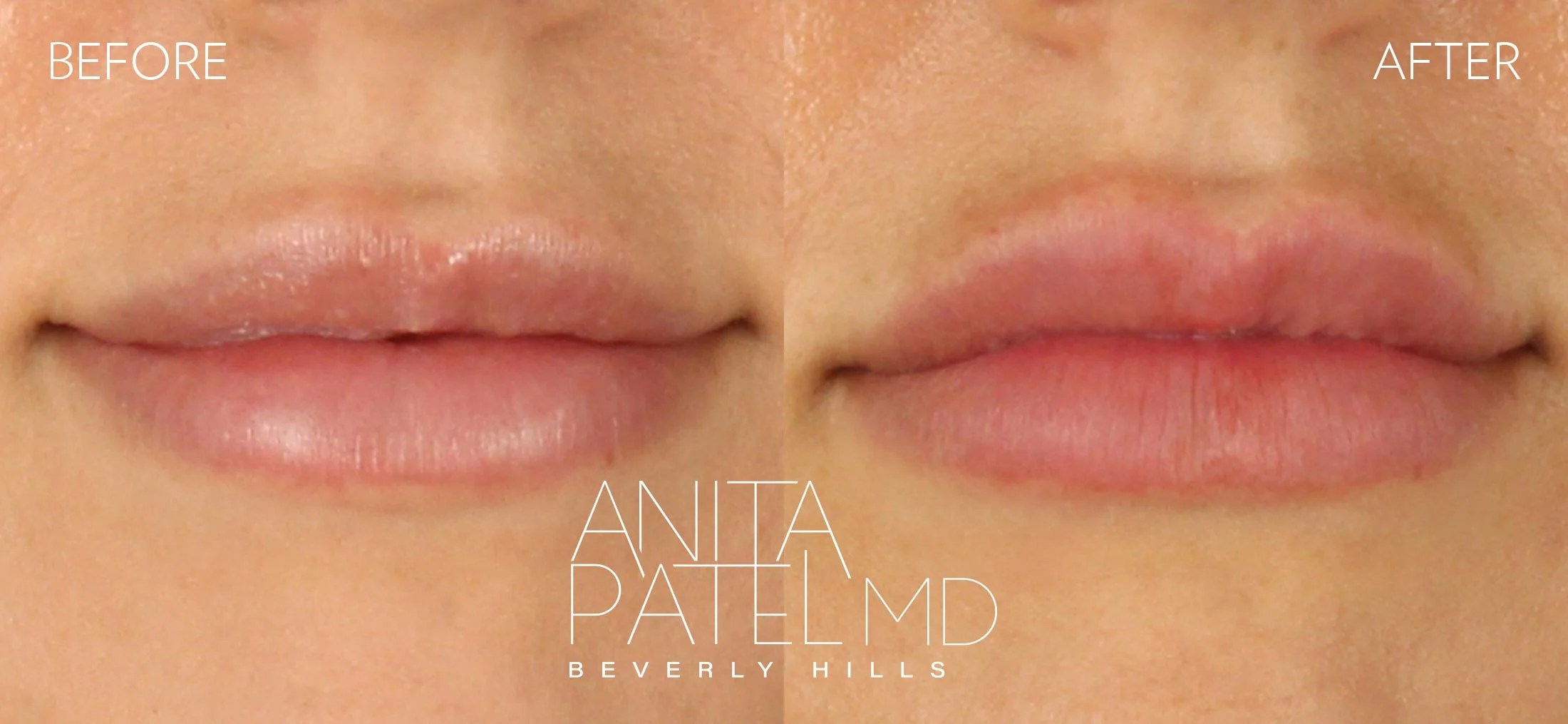 Castor Oil Lips Before And After