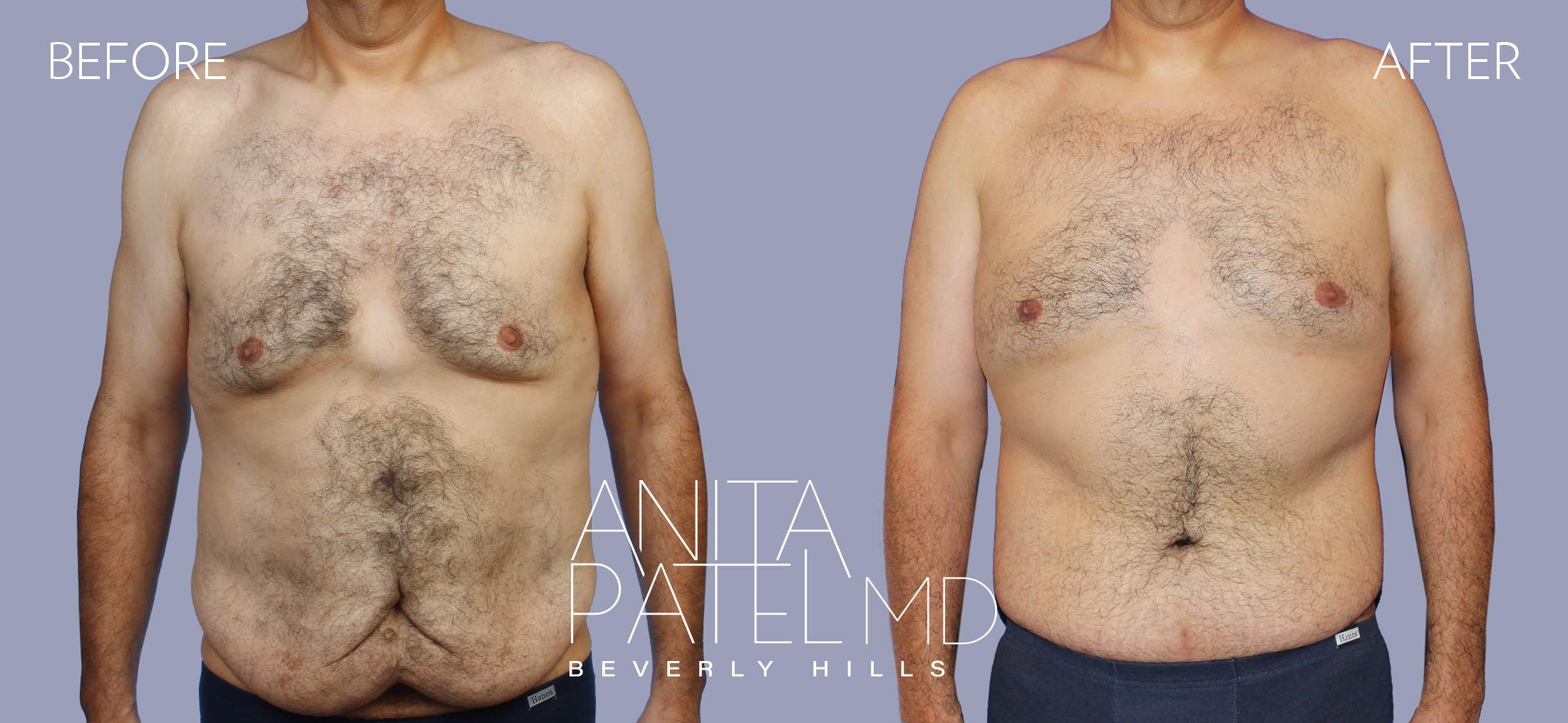 Beverly Hills Tummy Tuck Surgery Abdominoplasty Los Angeles
