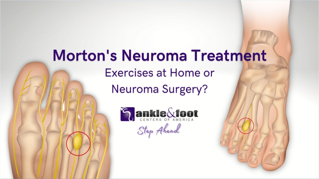 Morton’s Neuroma Treatment Exercises at Home or Neuroma Surgery