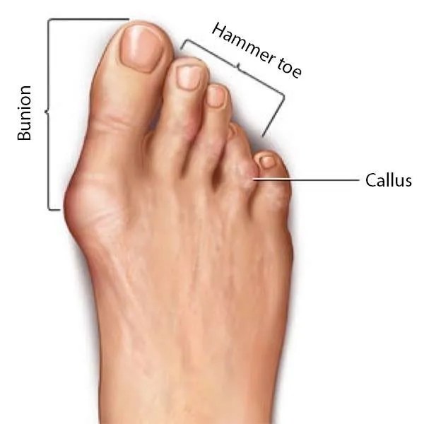 Common Foot Disorders Ankle and Foot Specialist