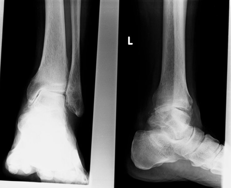 Ankle Arthritis Ankle & Foot professional solutions limited