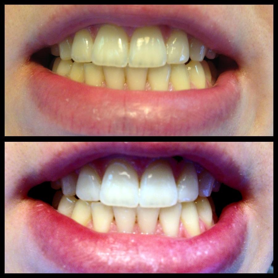 Downtown Vancouver Dental Hygienist Services Anna Vardi, RDH Gallery