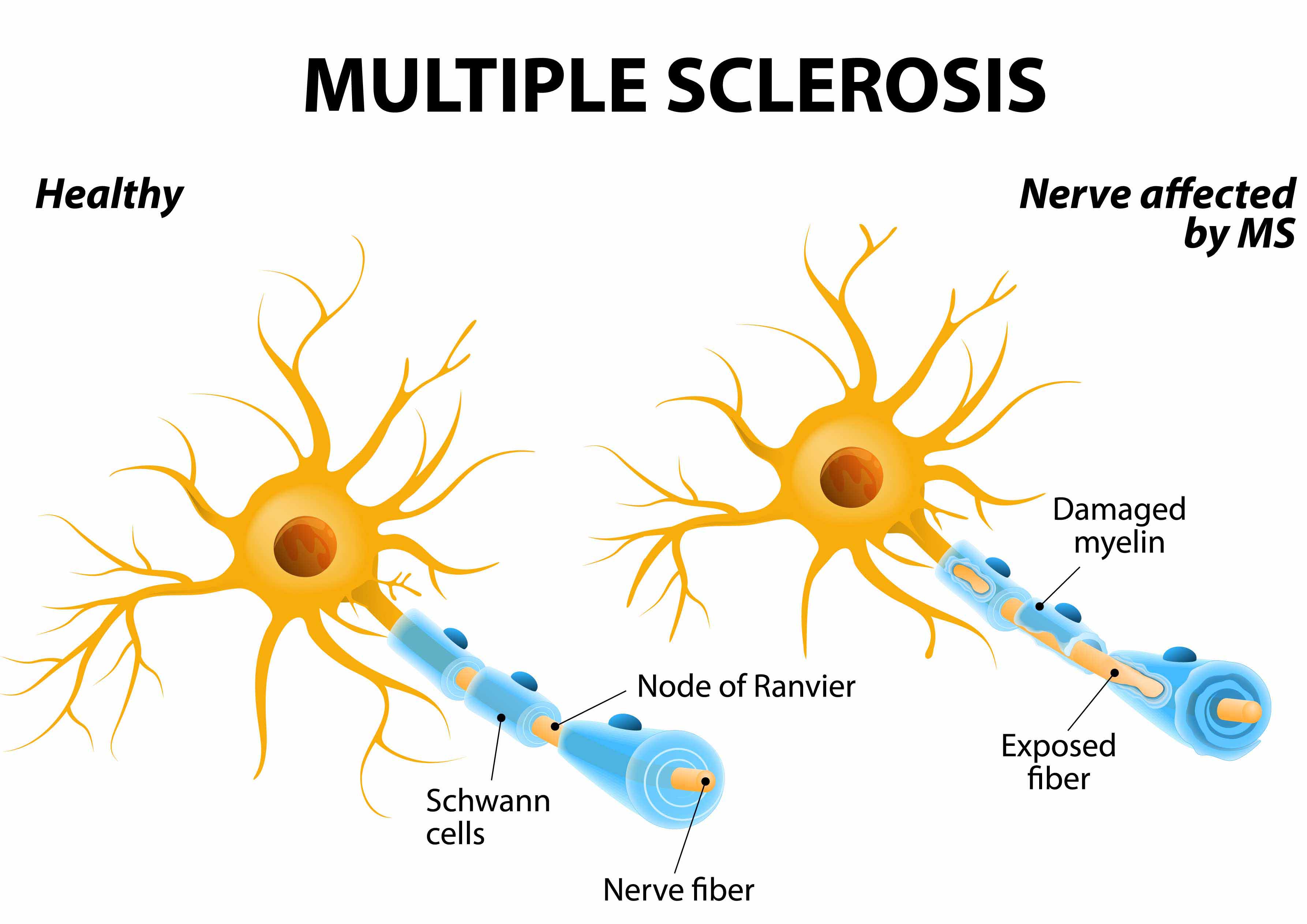 Multiple Sclerosis (MS) ANOVA IRM Germany