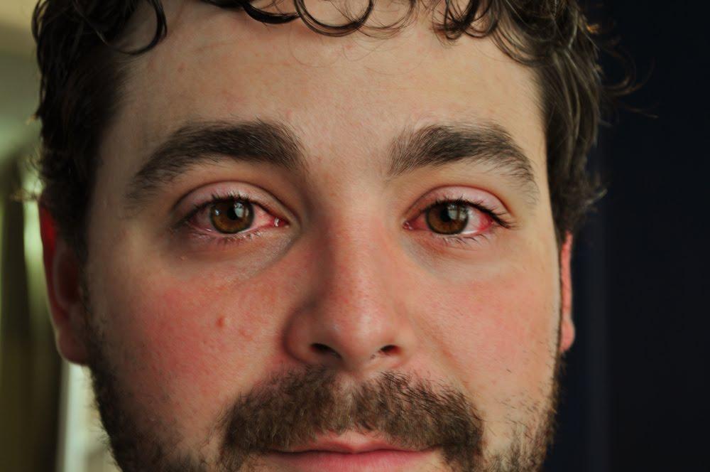 pink eye, pink eye question and answers Firmoo Answers