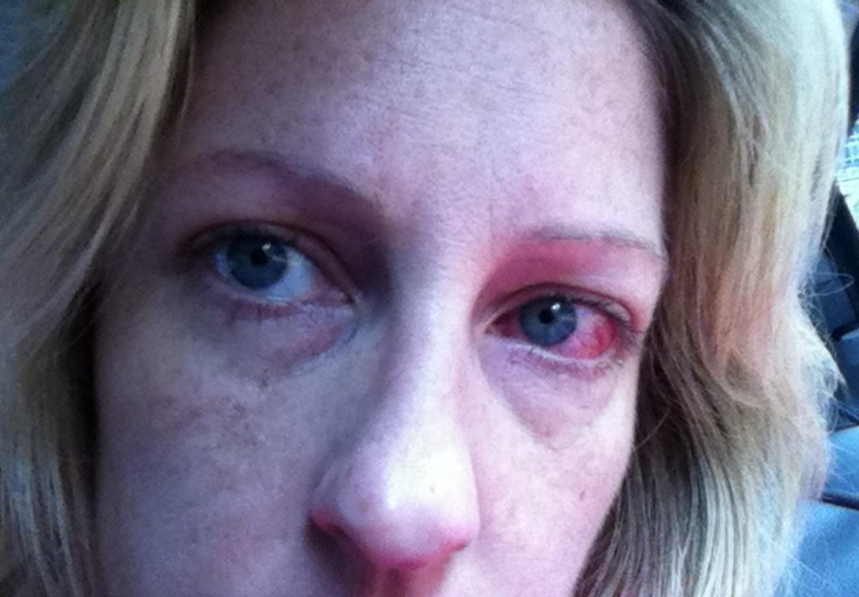 pink eye, pink eye question and answers Firmoo Answers