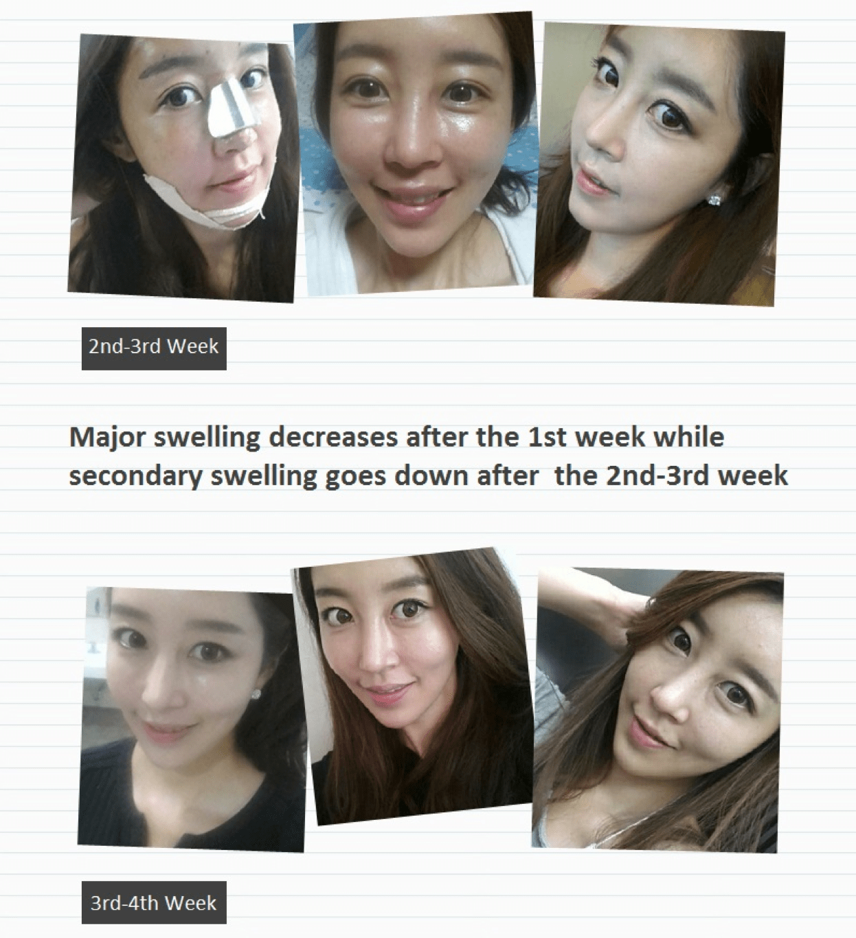 Fat Grafting, Facial Contouring, Rhinoplasty Before & After Answer