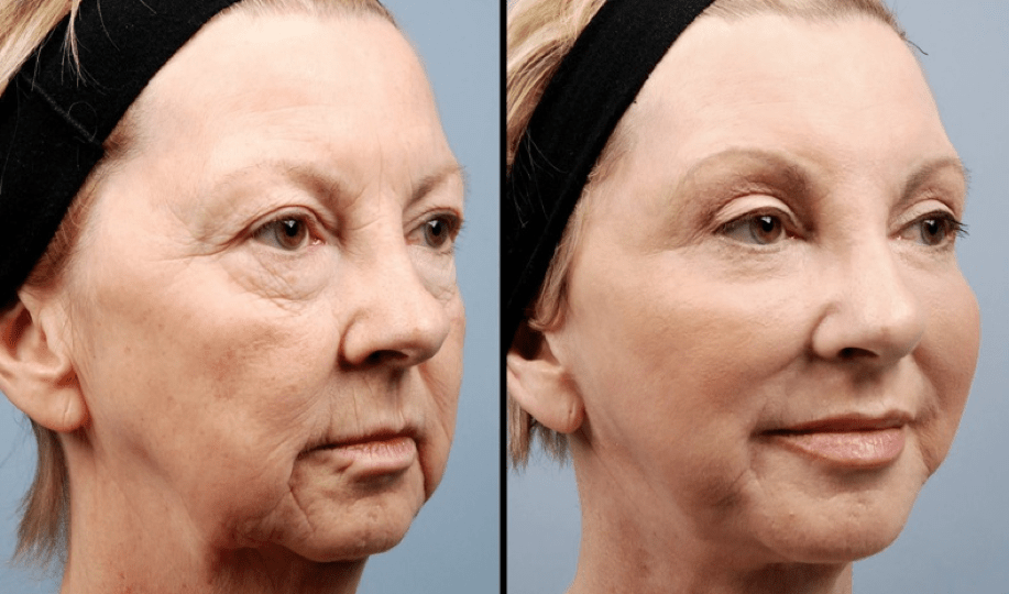 Fat Grafting Surgery In Korea, How Fat Grafting Works Answer Plastic