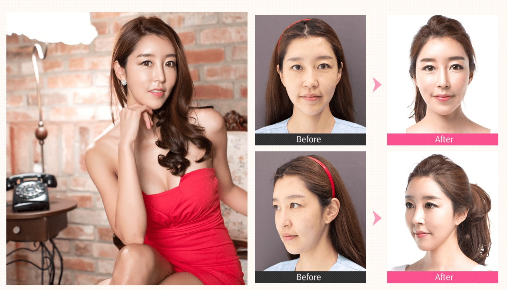 Fat Grafting, Facial Contouring, Rhinoplasty Before & After Answer