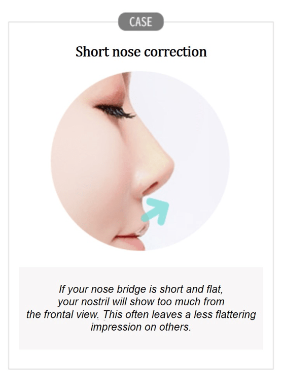 Short Nose Correction Answer Plastic Surgery