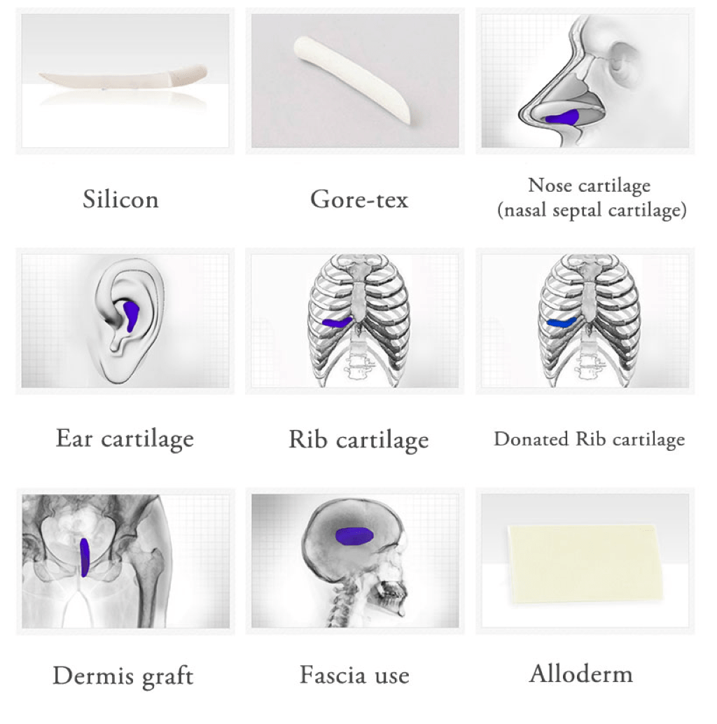 Ear Cartilage Rhinoplasty