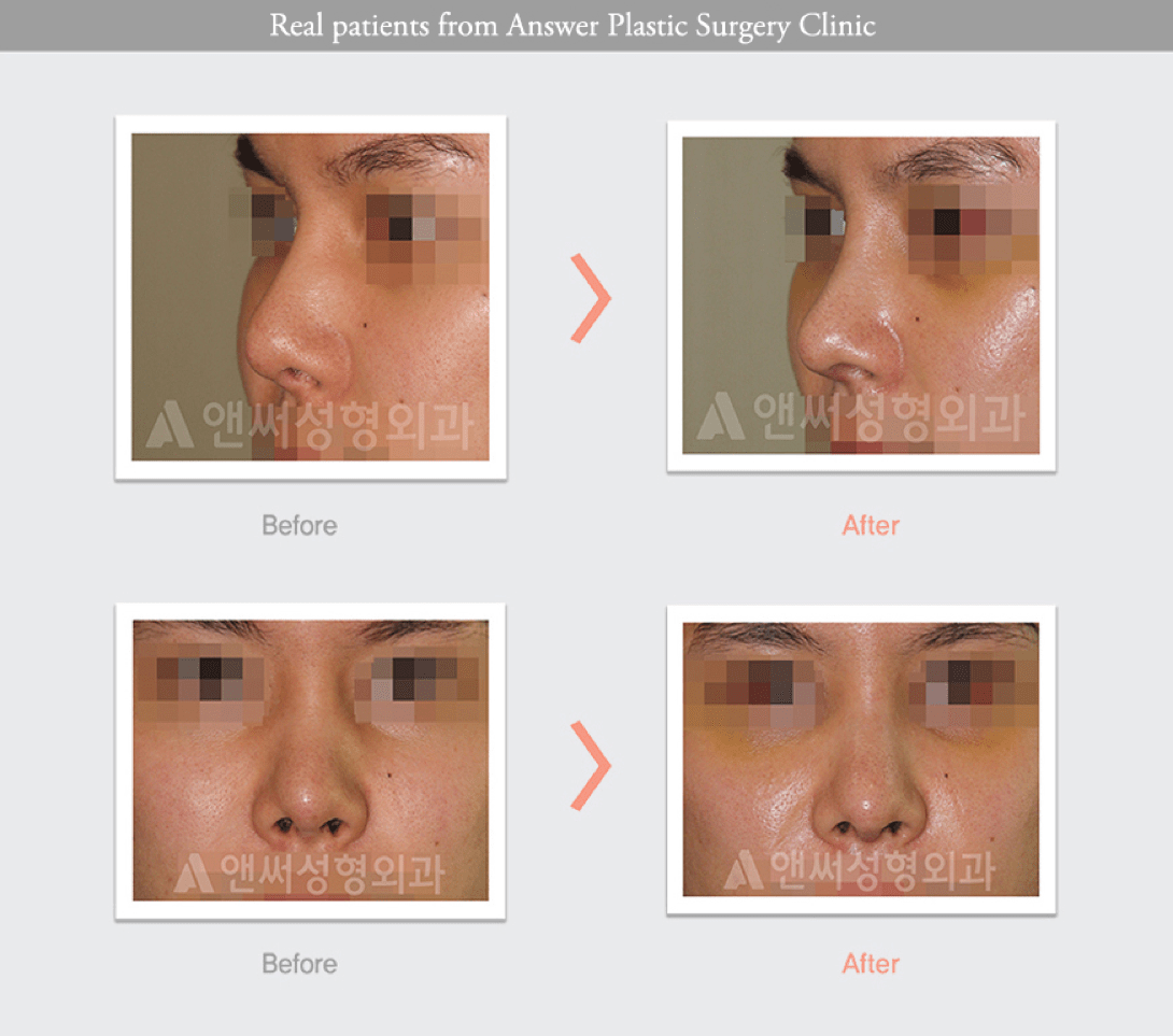 Korean Nose Job Cost